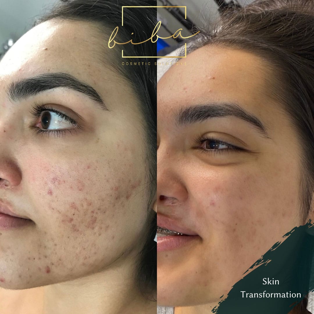 before and after Skin Needling treatment at biba skin care clinic