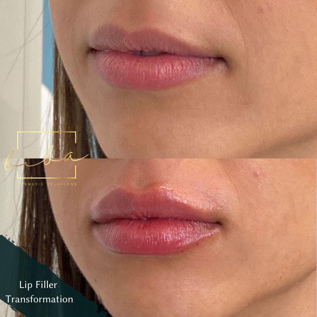 lip injections results from our Cosmetic Clinic Parramatta
