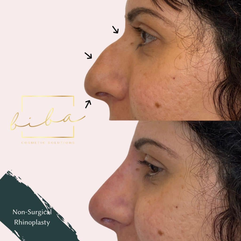 a before and after of a patient who has undergone a non surgical rhinoplasty treatment at biba cosmetic solutions clinic