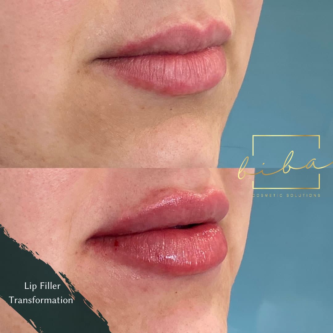 lip fillers results from our clinic in sydney