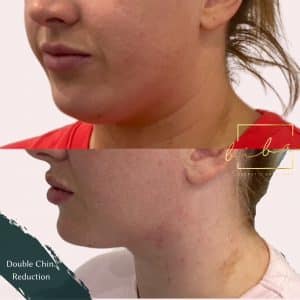 before and after double chin reduction at Biba skin care Clinic Parramatta