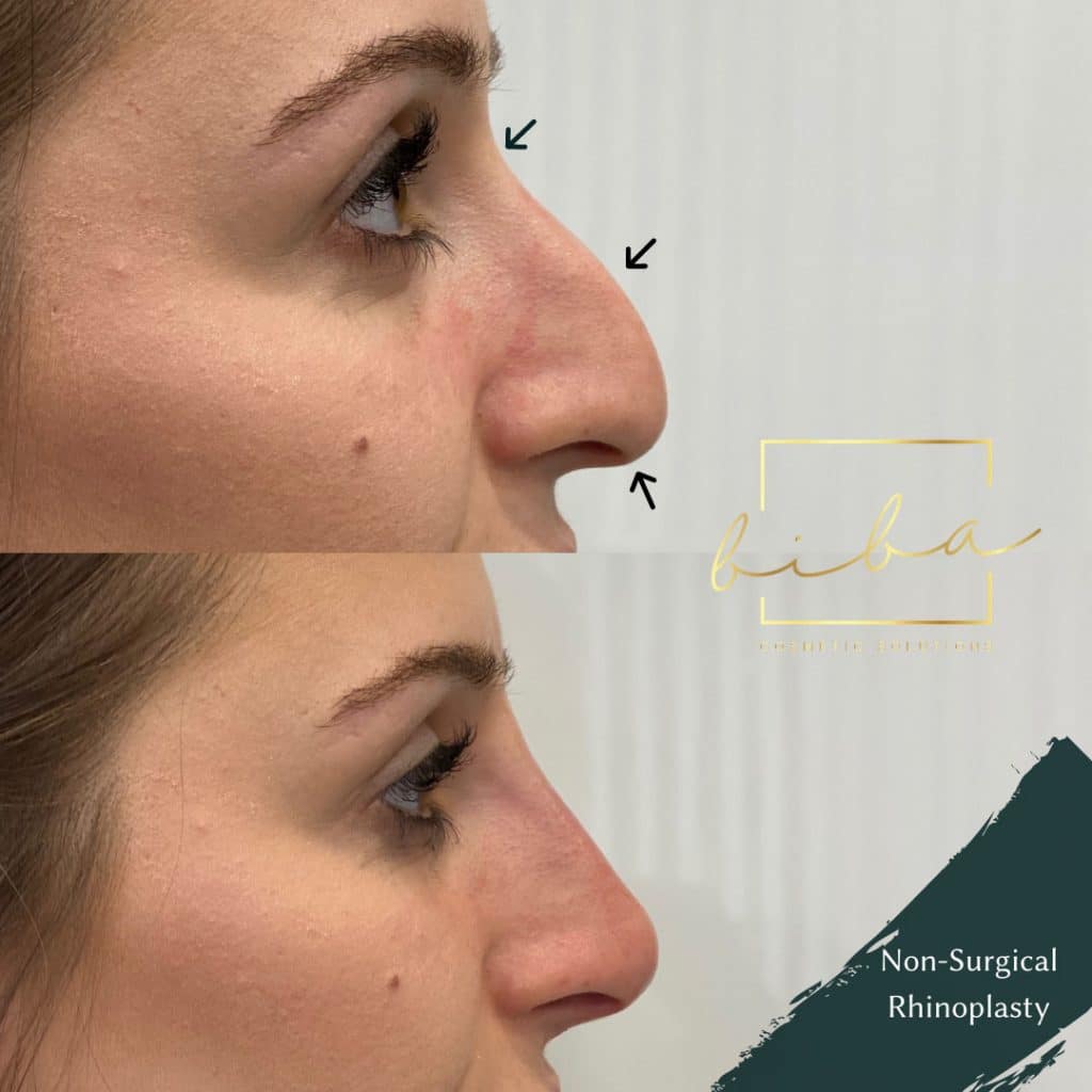 a before and after of a patient who has undergone a non surgical rhinoplasty treatment