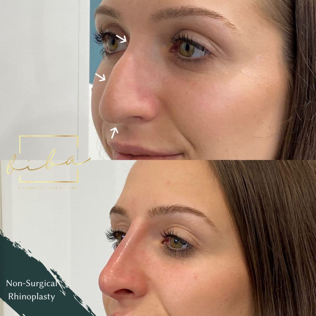 a before and after of a patient who has undergone a non surgical nose job treatment at biba