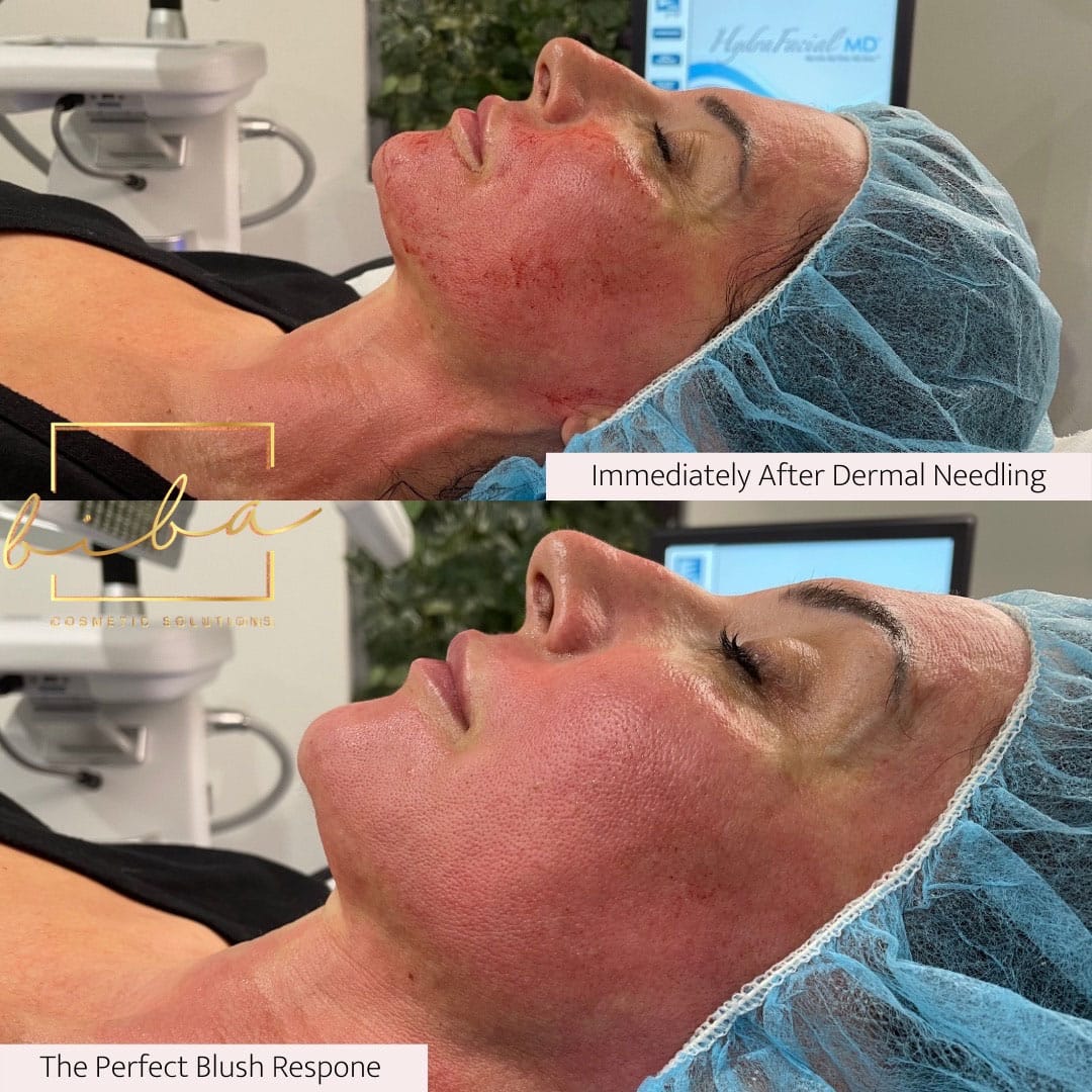 Before and after Skin Tightening treatment at biba skin care clinic