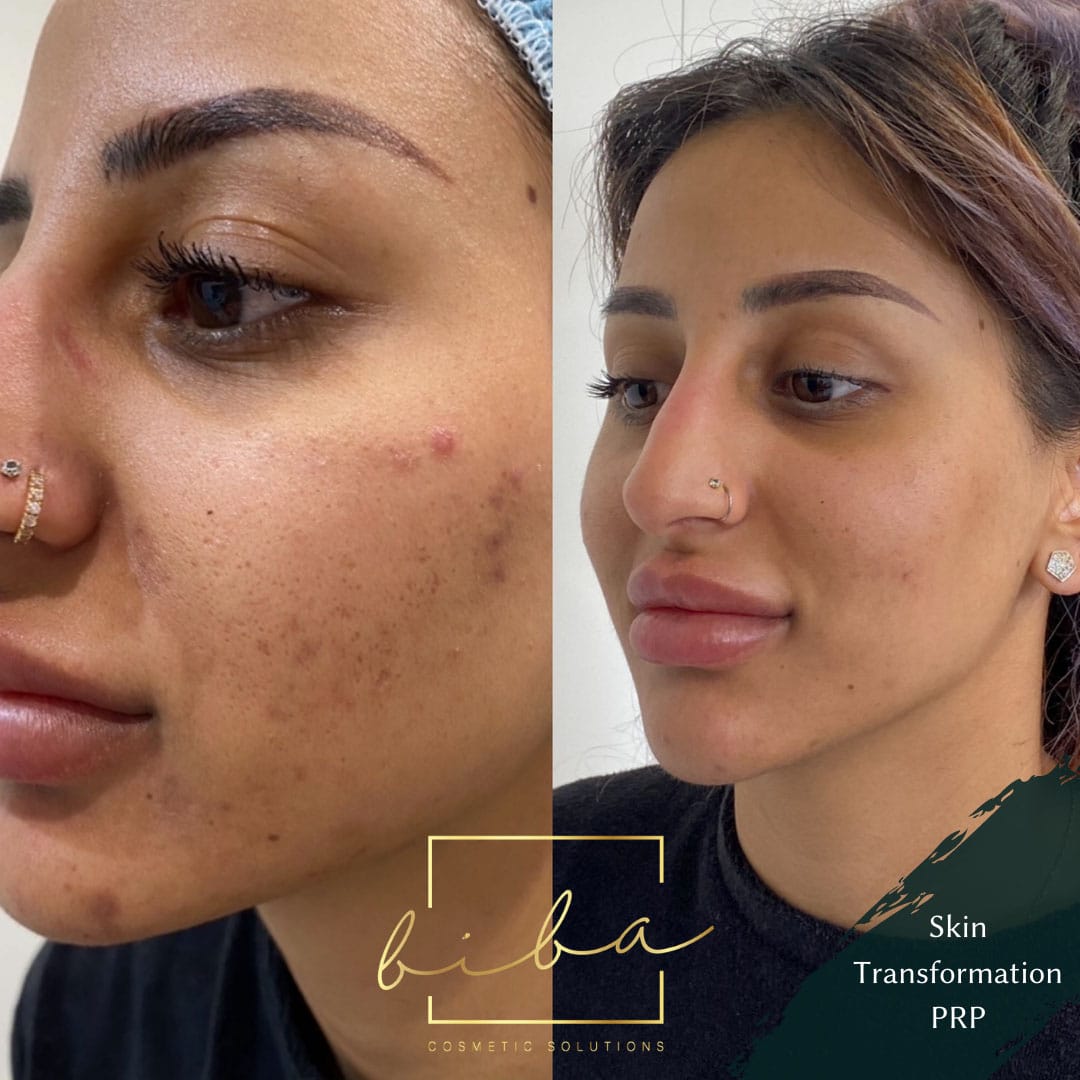 before and after Chemical Peels treatment at biba skin care clinic