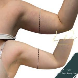 before and after of arm reduction treatment at biba skin care clinic through the use of Trusculpt iD