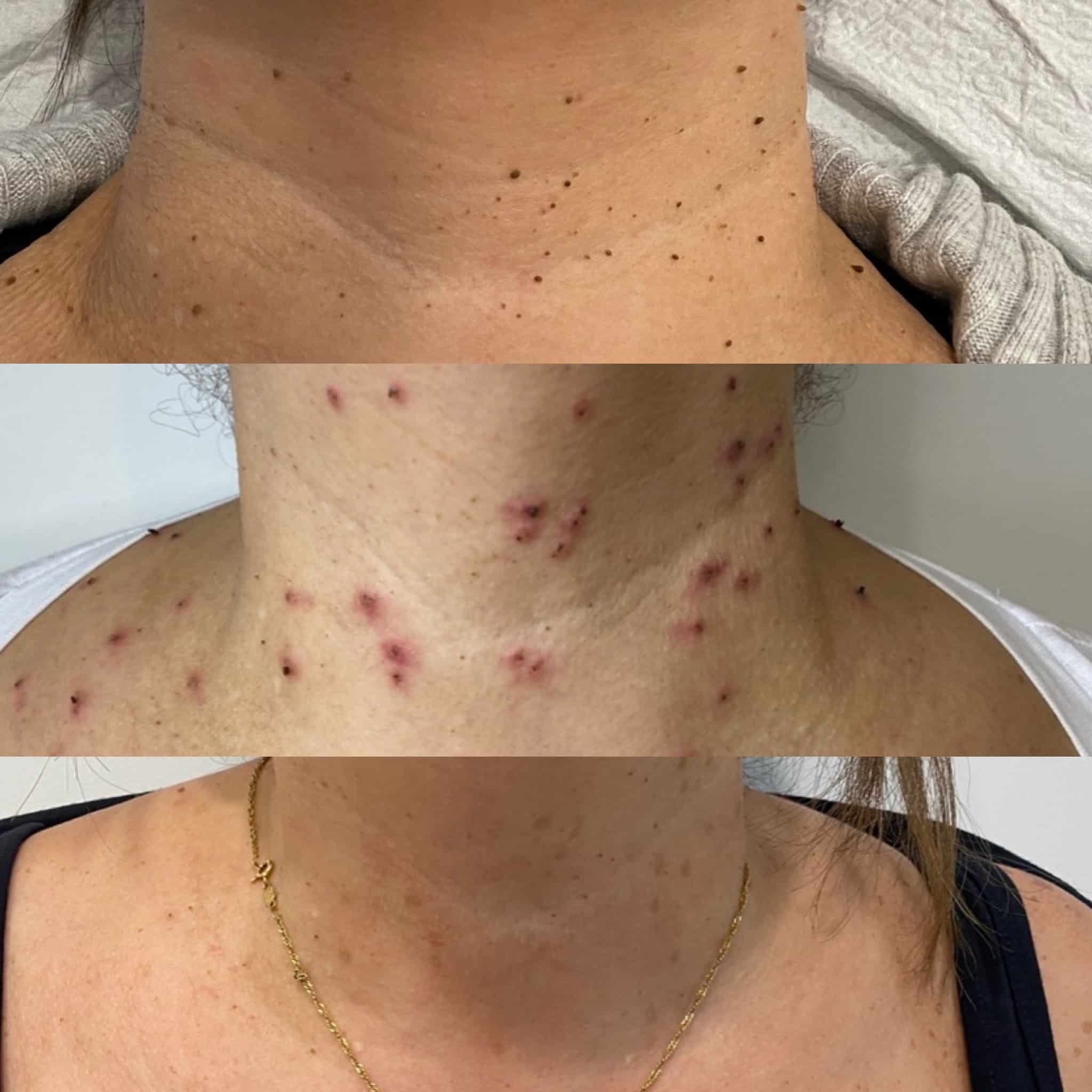 before and after shots of excel v treatment on a client's neck