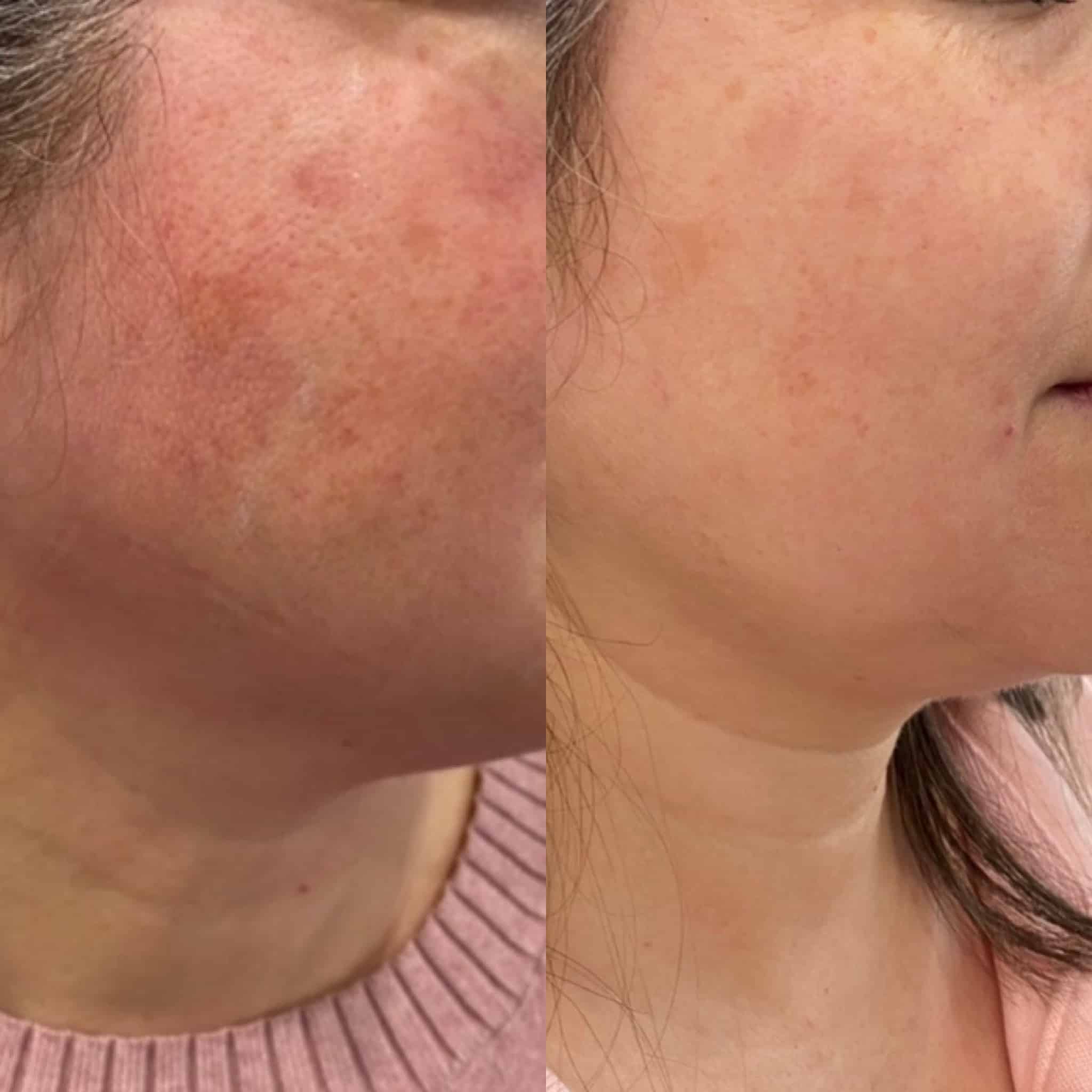before and after shot of excel v treatment on a client's face