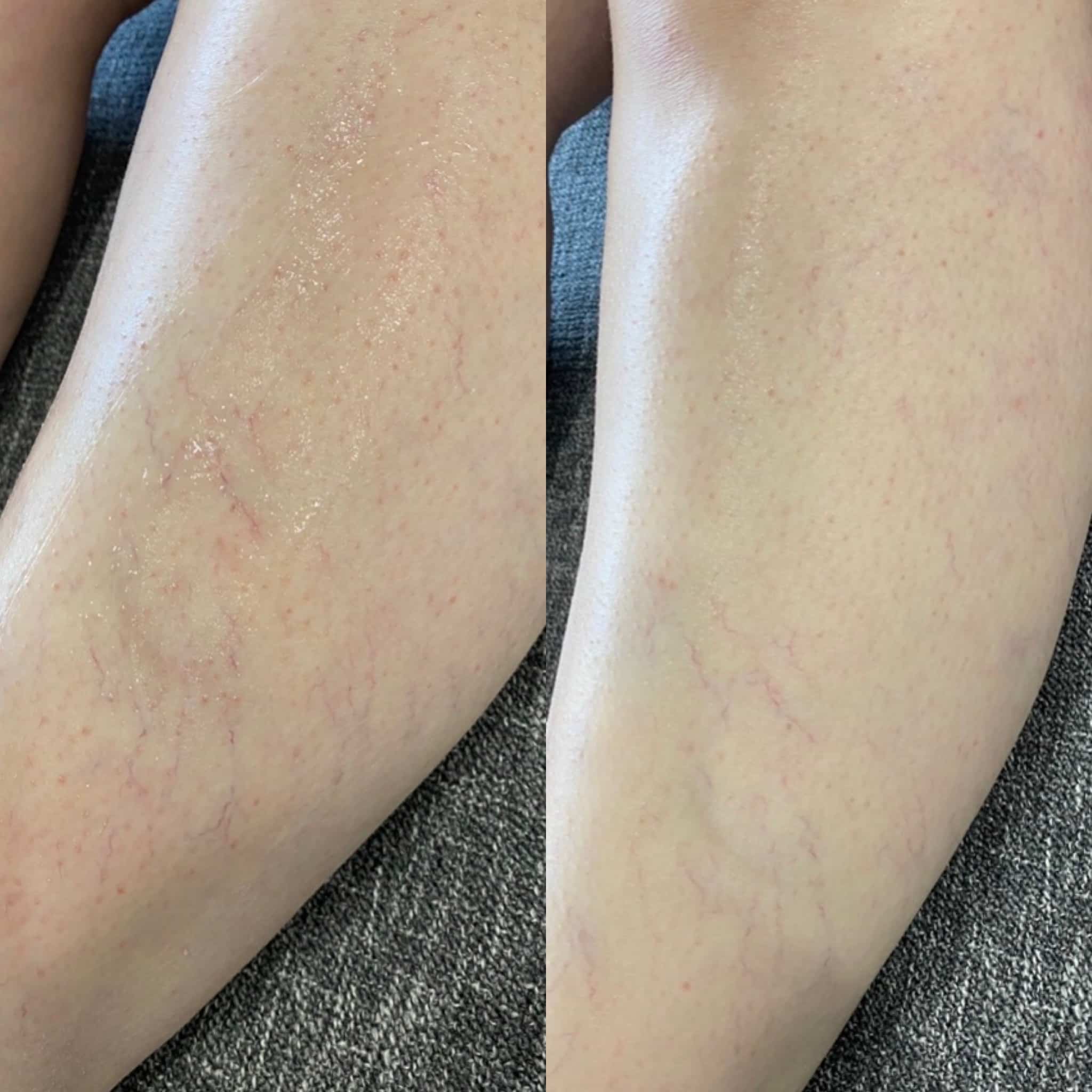 before and after shot of excel v treatment on a client's legs