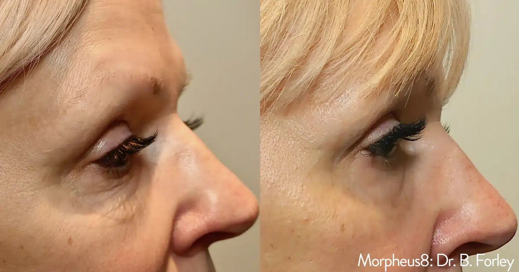 Eyes Morpheus8 treatment at biba cosmetic clinic in parramatta