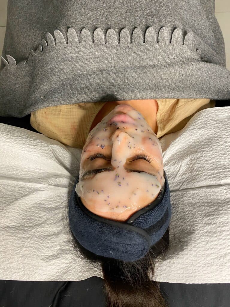 Chemical peels being done onto a client