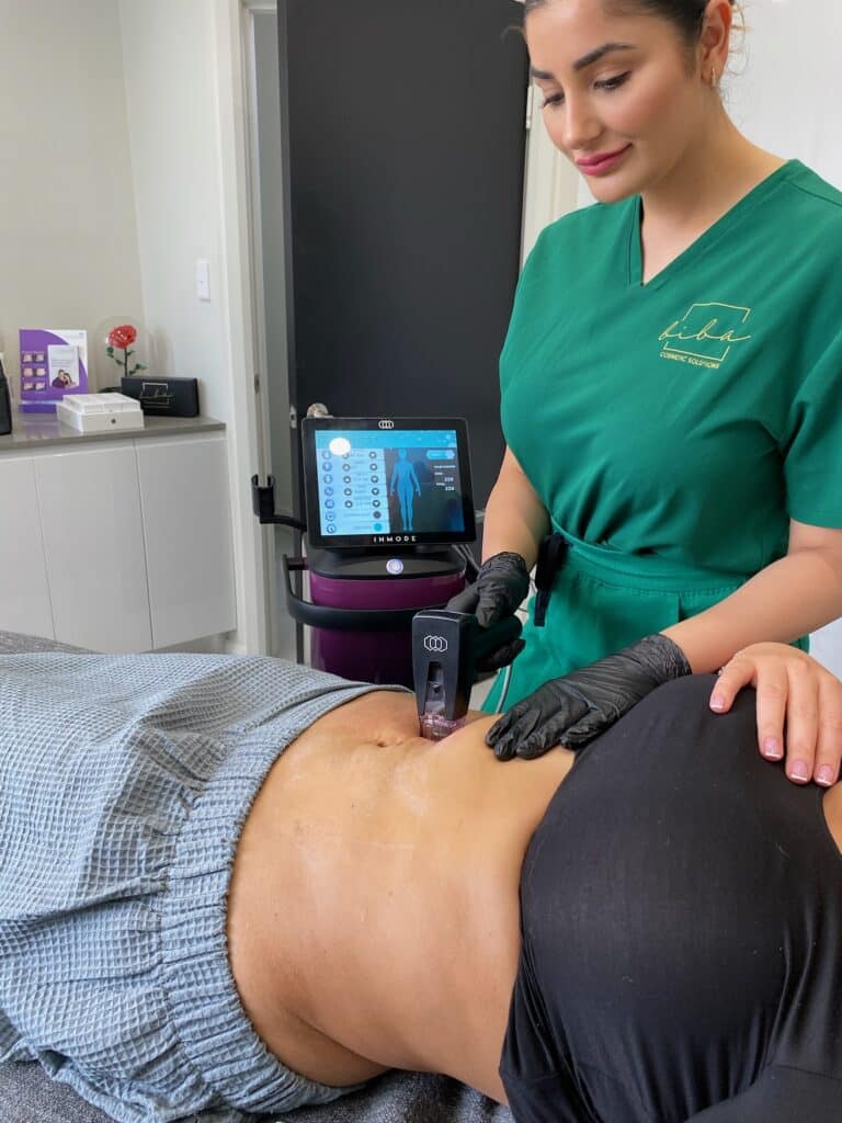 morpheus8 treatment being performed by a registered nurse on a customer