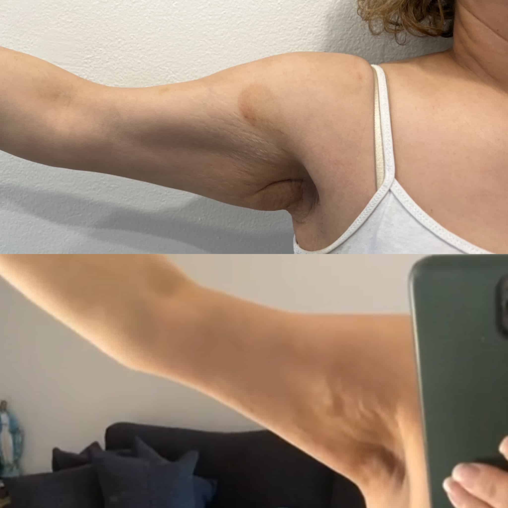 arm transformation after trusculpt id treatment at our skin care clinic parramatta