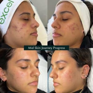 mid skin journey progress with excel v laser