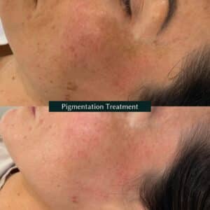 excel v laser treatment before and after
