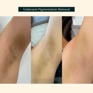 underarm pigmentation removal before and after