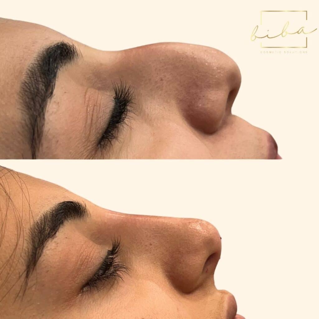 results from a non surgical rhinoplasty injectables treatment