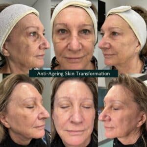 before and after images of an anti ageing treatment