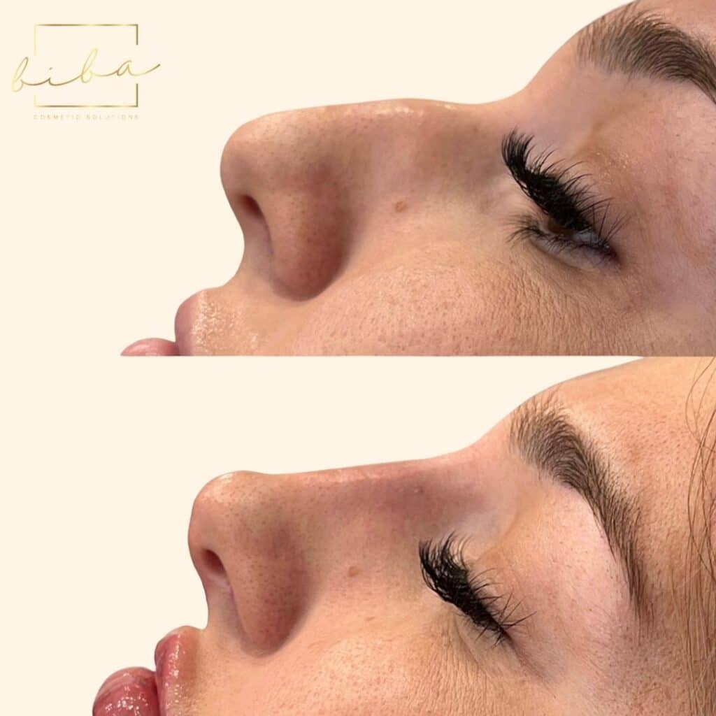 a non surgical nose job transformation on a patient at BIBA Cosmetic Solutions