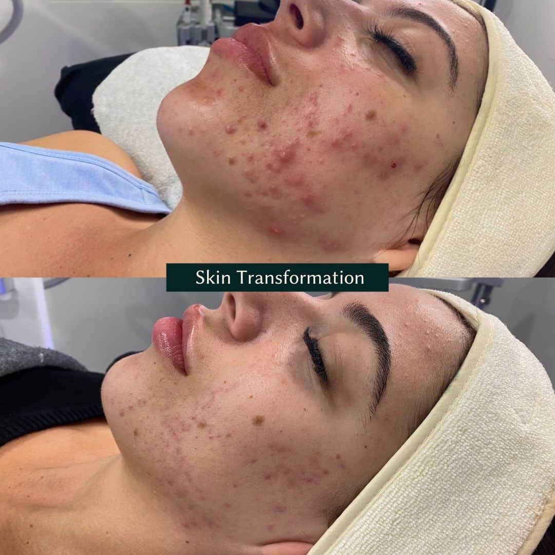 face skin before and after results from a hydrafacial