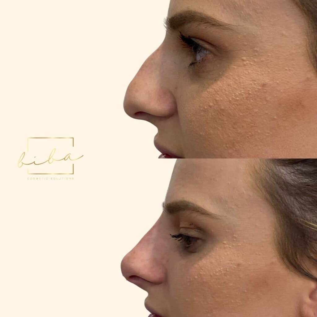 nose transformation for a non surgical rhinoplasty injectable treatment