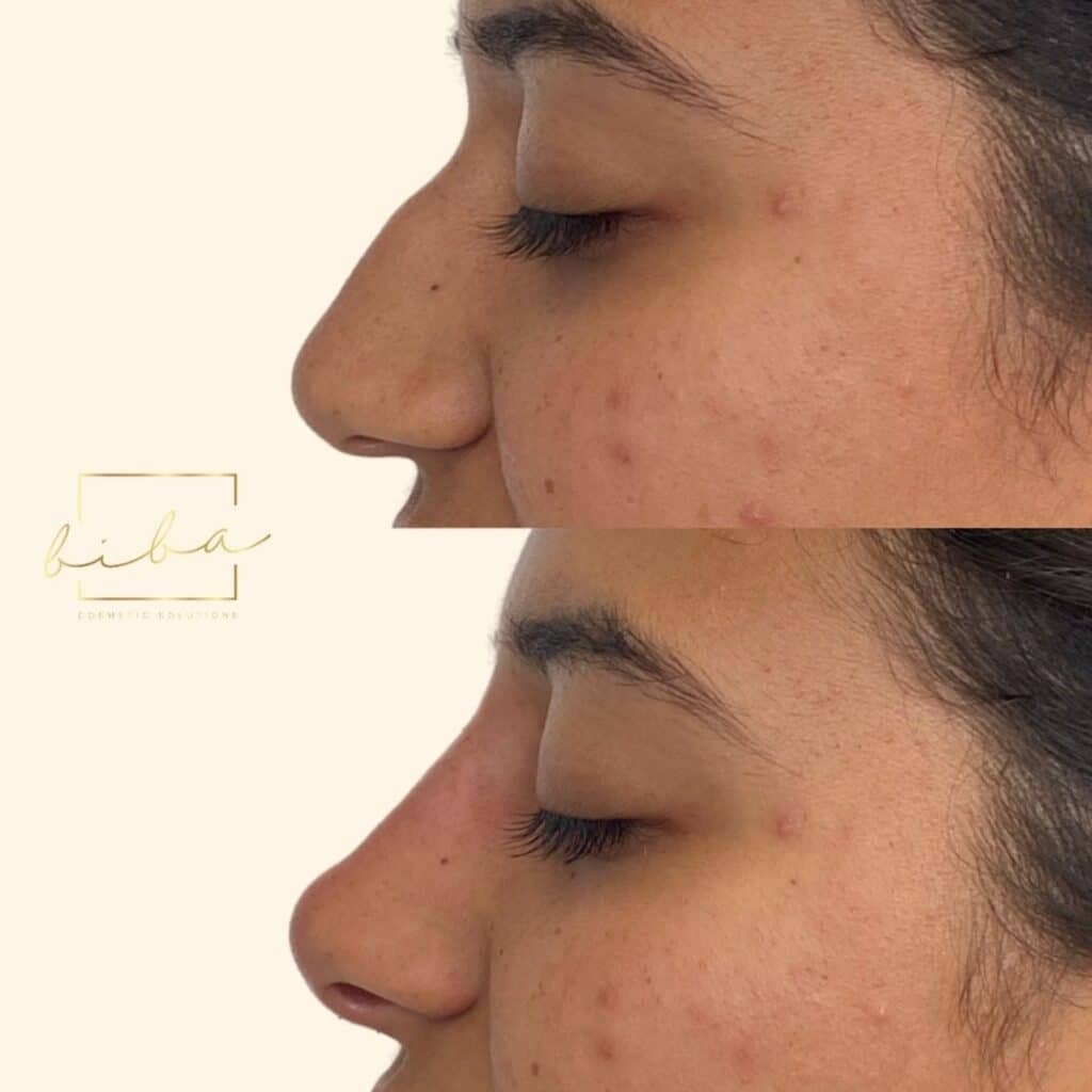 before and after images of a patient who has undergone a non surgical nose job treatment
