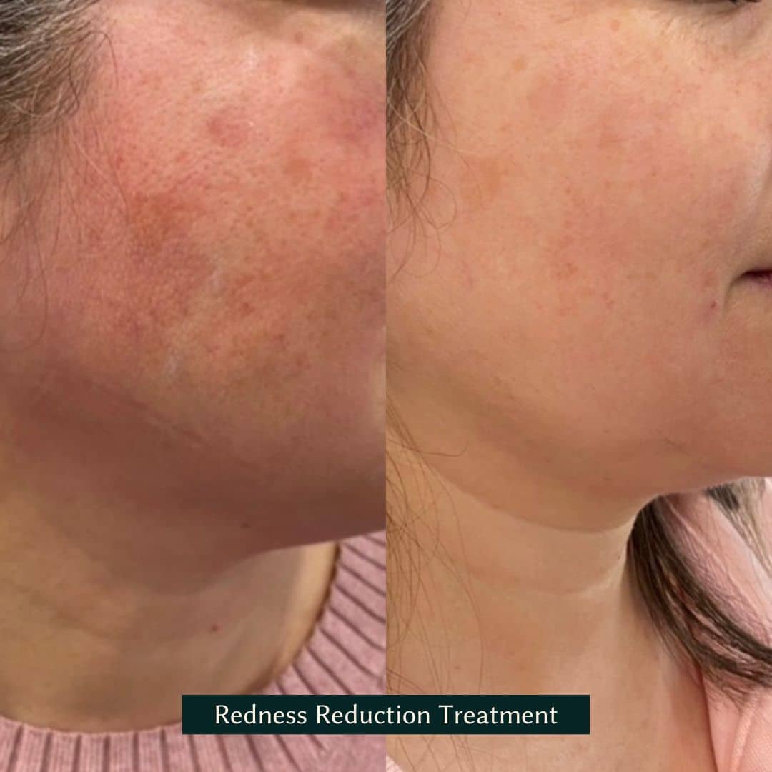 face transformation as a result of skin needling