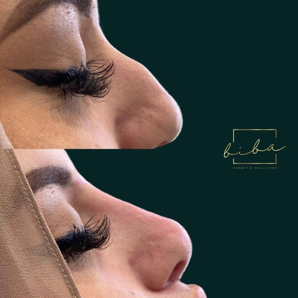 nose bridge before and after from a non surgical nose job treatment at BIBA Cosmetic Solutions