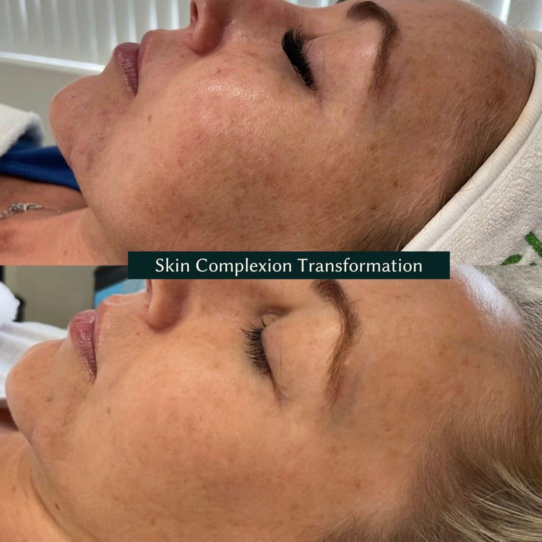 chemical peels transformation results for a patient's face