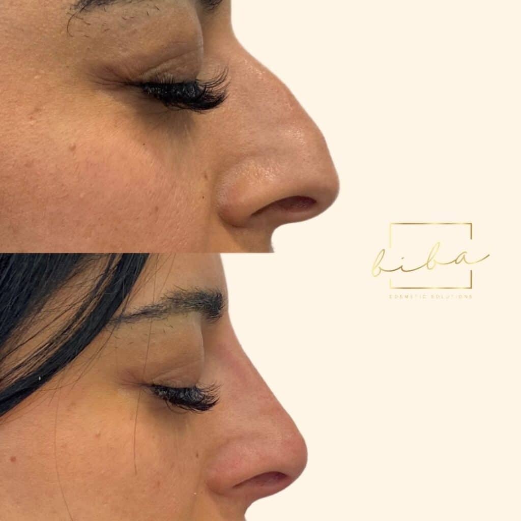 nose transformation after a non surgical nose job treatment