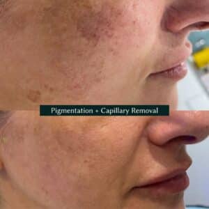 face transformation from a pigmentation and capillary removal