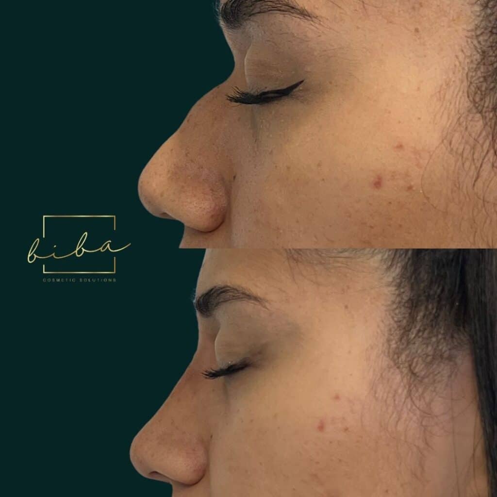 a before and after of a patient who has undergone a non surgical rhinoplasty treatment