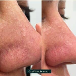 nose transformation from capillary removal
