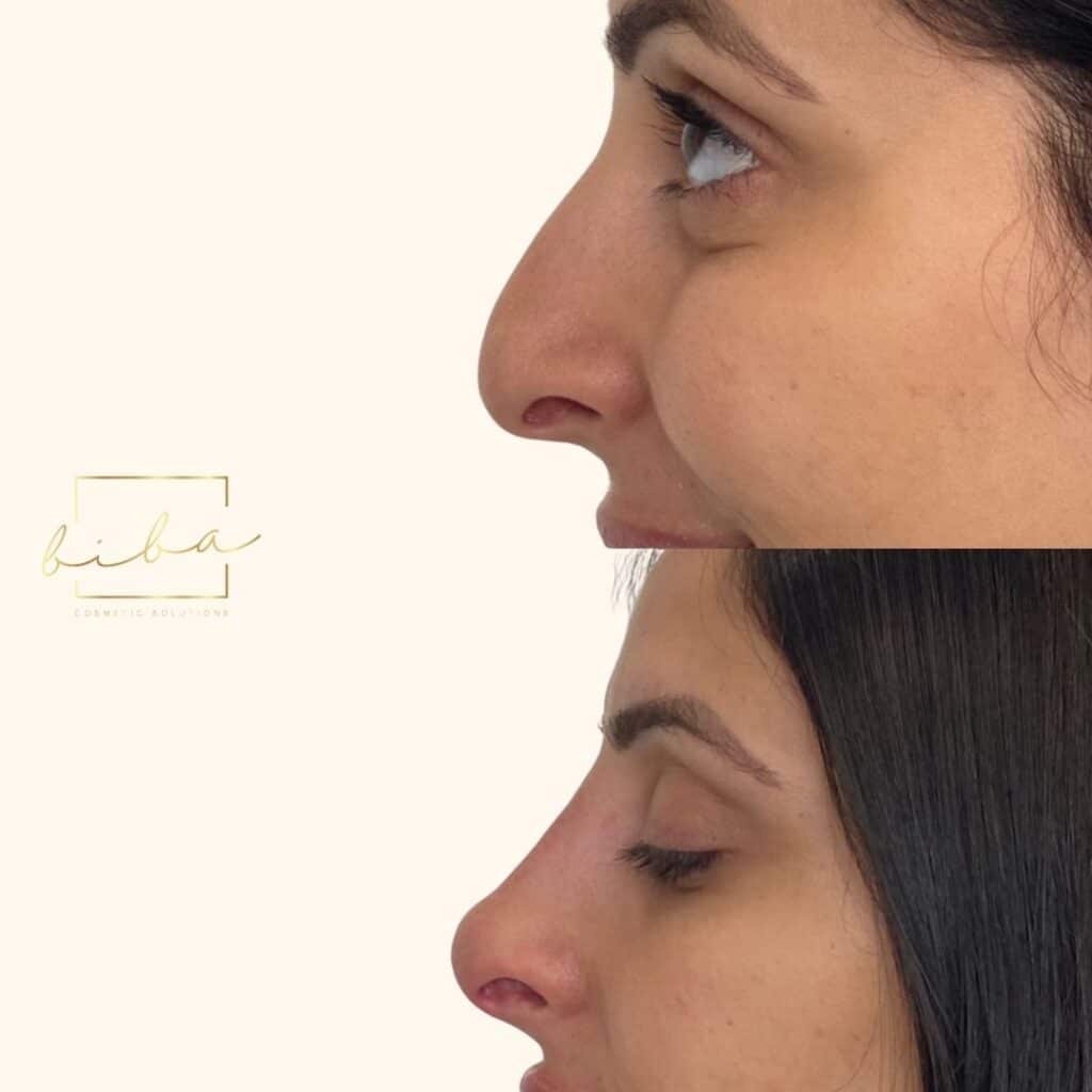 transformation photo of a nose that has completed a non surgical nose job treatment