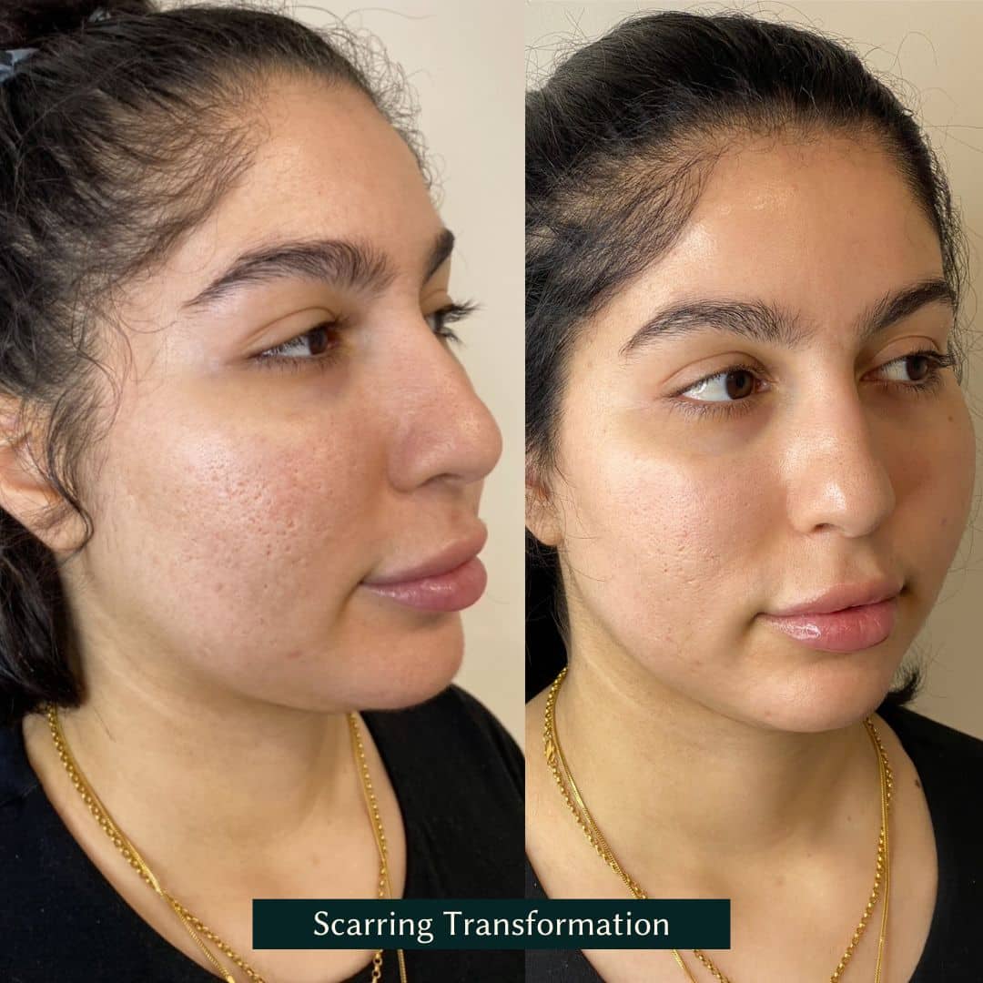 scarring reduction from skin needling
