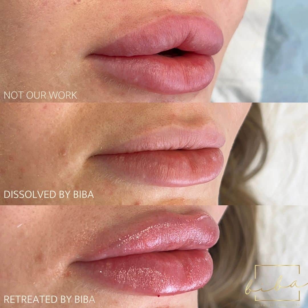 lips before and after after lip fillers by BIBA
