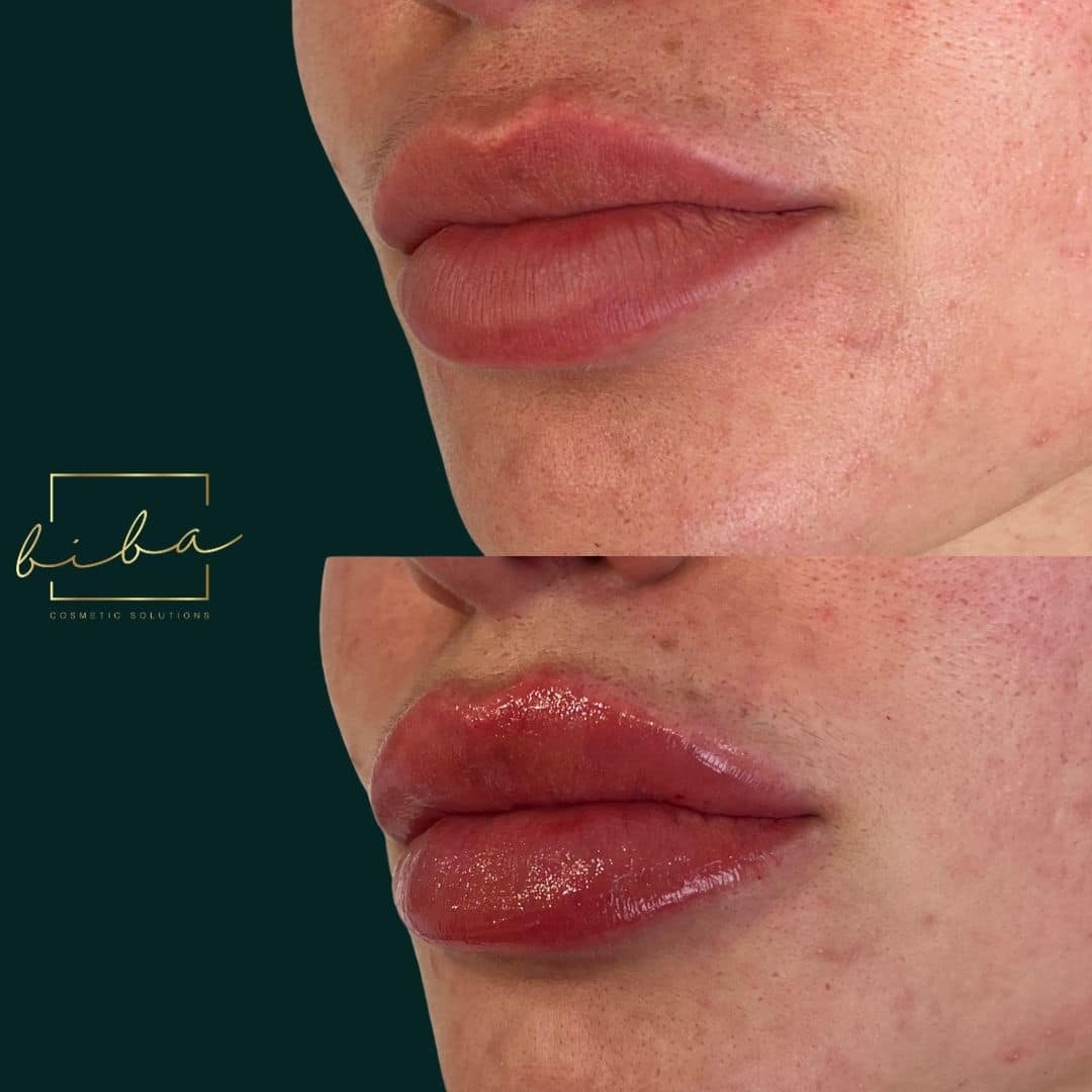 lips before and after from lip fillers by our cosmetic clinic in parramatta