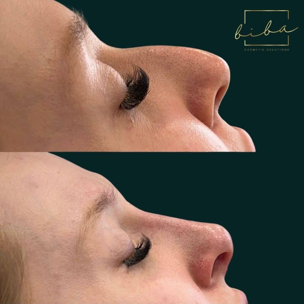 non surgical nose job results