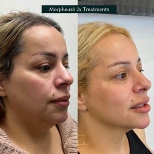 face transformation after morpheus treatment