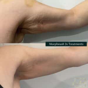 before and after of arms after a morpheus8 treatment
