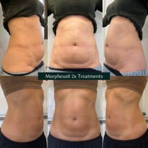 stomach transformation after morpheus8 treatment