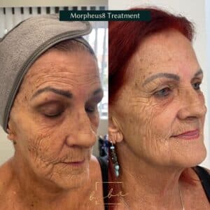 face before and after from our morpheus8 treatment