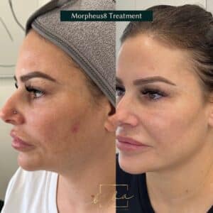 face transformation from morpheus treatment at BIBA Cosmetic Clinic Solutions