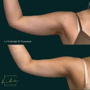 arm before and after after our skin treatment
