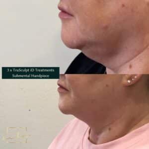 neck and chin before and after from a trusculpt id treatment at our skin care clinic parramatta