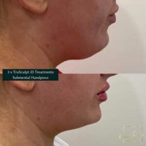 lower face transformation from our cosmetic clinic parramatta