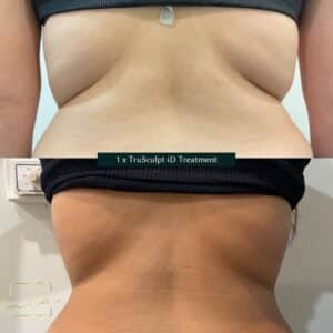back transformation after trusculpt id treatment at our skin care clinic parramatta