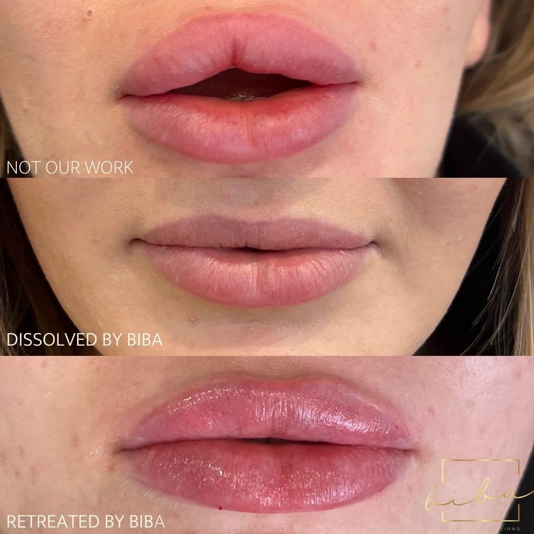 lip fillers transformation from our skin clinic in parramatta
