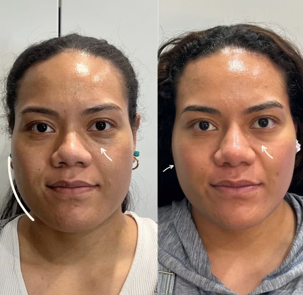 this image shows the dramatic results from a morpheus8 treatment used by a cosmetic clinic in parramatta