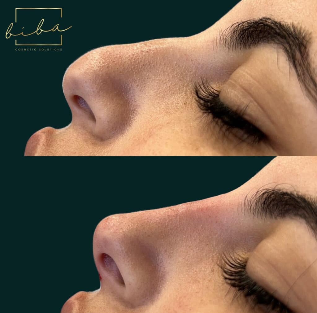 image shows a non surgical rhinoplasty or non surgical nose job that was created at a cosmetic clinic parramatta